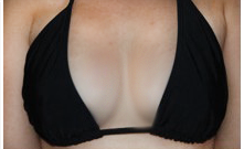 Size - C - Natural breast enlargement